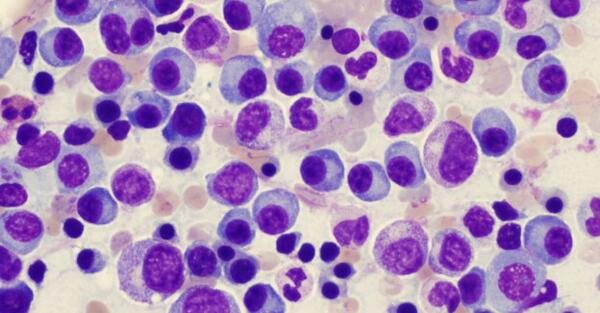 La ricerca Made in Italy supporta la lotta al mieloma